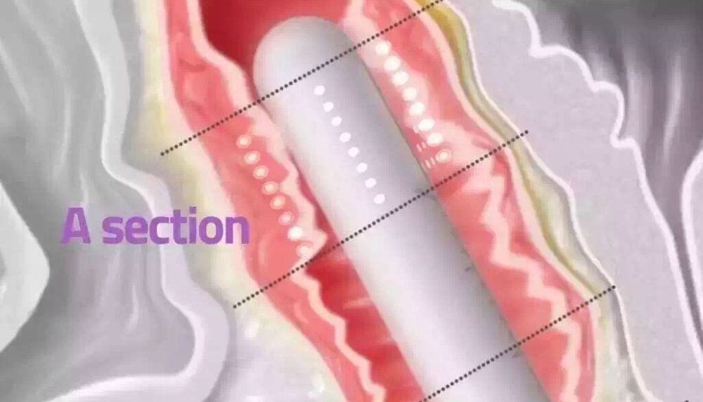 vaginal hifu